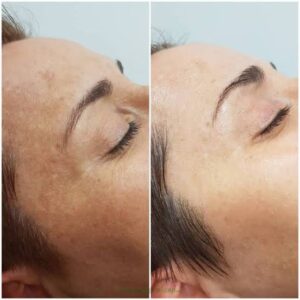 chemical peel before and after results