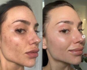 chemical peel before and after results