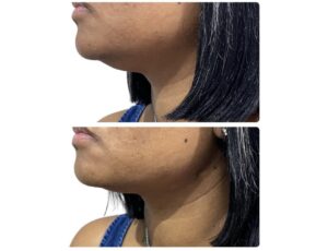 facelift using PDO threads
